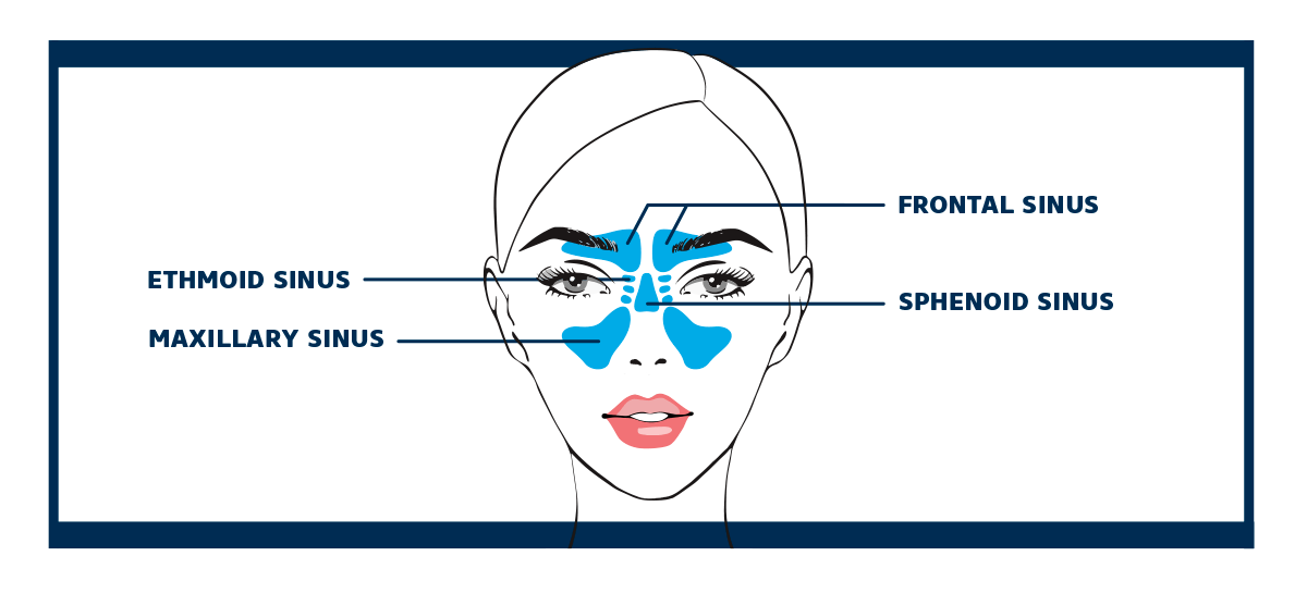 Inflammation des sinus (sinusite)